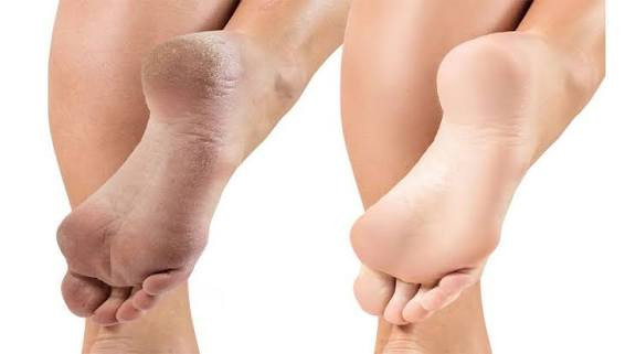 سوهان برقی پا با قابلیت لایه برداری